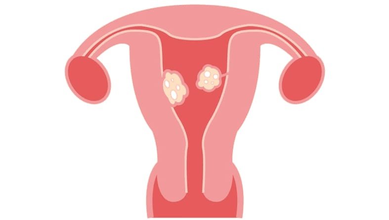 Uterine Fibroid And Infertility | Causes, Symptoms & Treatments Uterine Fibroid And Infertility | Causes, Symptoms & Treatments